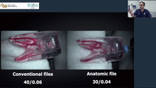 Load image into Gallery viewer, 3D conservative cleaning of the root canal