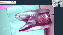 Load image into Gallery viewer, 3D conservative cleaning of the root canal