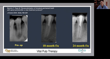 Load image into Gallery viewer, The role of vital pulp therapy
