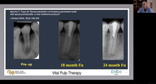 Load image into Gallery viewer, The role of vital pulp therapy
